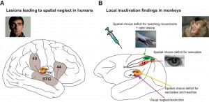 Figure 3. A, Major cortical and subcortical brain regions where lesions lead to spatial neglect in humans (left), and corresponding recent experimental results in monkeys (right) (lateral view). In humans, lesions in frontal (Brodmann area 44), inferior parietal cortex (Brodmann area 40), superior temporal gyrus (STG), basal ganglia, and pulvinar have been reported to lead to spatially biased behavior that might appear as a visual consciousness deficit (Karnath, 2001). B, Recent pharmacological inactivation studies in monkeys have shown primarily effector-specific spatial deficits after lesions in parietal subregions such as the lateral intraparietal area (LIP, red shading) and the parietal reach region (PRR, which includes the medial intraparietal area MIP and area V6A, green shading). Dorsal pulvinar (dPULV, orange shading) inactivation leads to spatial orienting bias for both eye and hand movements which can be compensated by visual reward cues, suggesting that visual perception might be preserved. Ventral pulvinar (vPULV, purple shading) inactivation leads to change detection deficits resembling visual neglect. Summarized from local inactivation studies in monkeys (Wardak et al., 2002; Wilke et al., 2010; Hwang et al., 2012; Wilke et al., 2012; Wilke et al., 2013; Hwang et al., 2014; Christopoulos et al., 2015; Katz et al., 2016; Zhou et al., 2016).